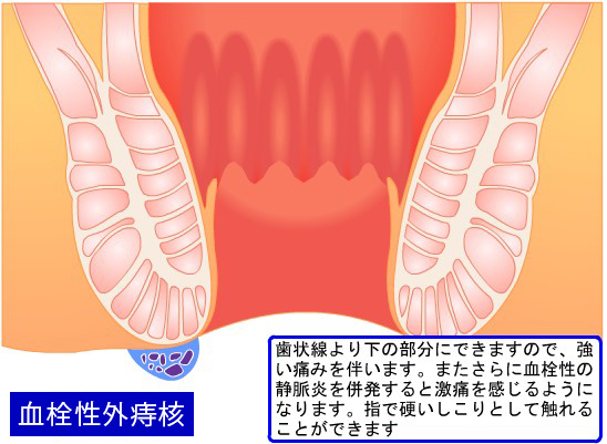 外痔核