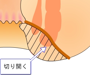 切開開放術