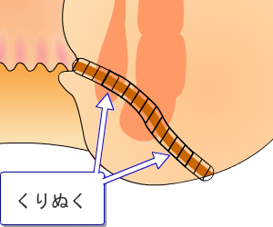 くりぬき法(Coring Out)