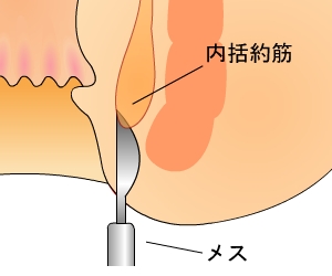 内括約筋側方皮下切開術