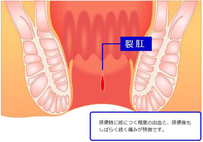 裂肛のイメージ