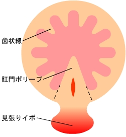 手術（皮膚弁移動術）